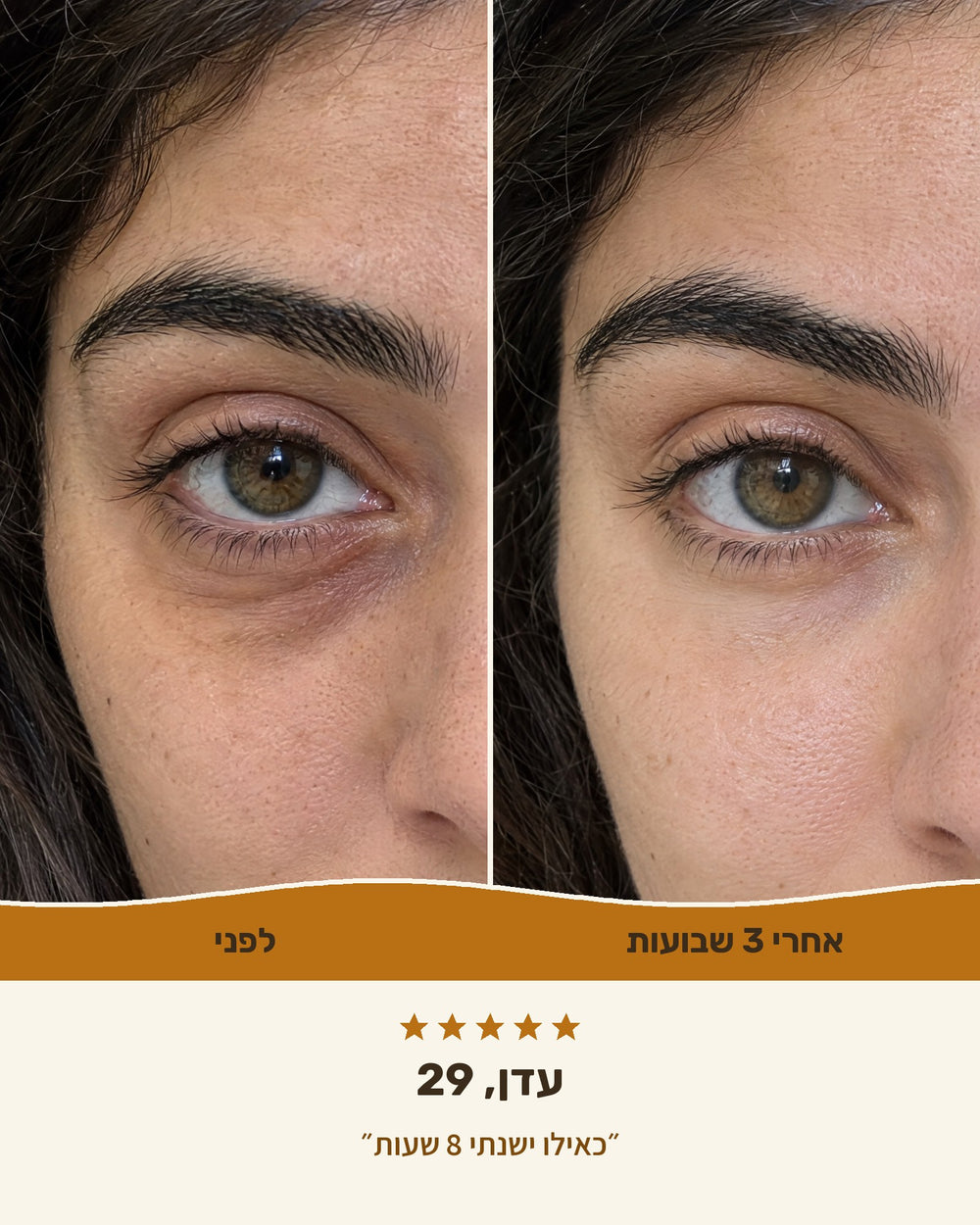 עדן, 29 — אזור העיניים לפני ואחרי 3 שבועות