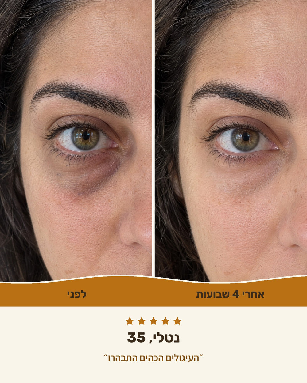 נטלי, 35 — אזור העיניים לפני ואחרי 4 שבועות