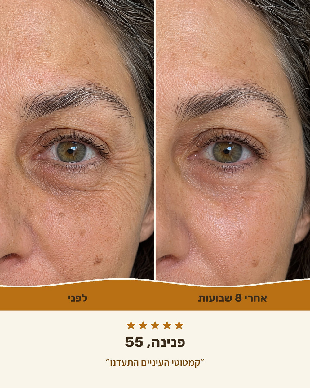 פנינה, 55 — אזור העיניים לפני ואחרי 8 שבועות