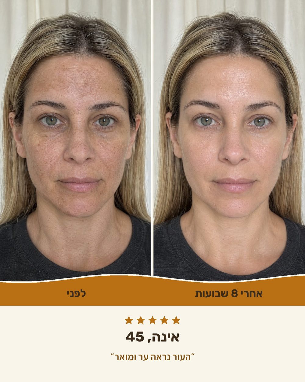 אינה, 45 — לפני ואחרי 8 שבועות עם קרם ויטמין C